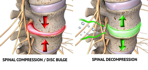 spinal decompression